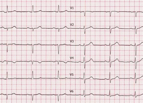 sanita ECG